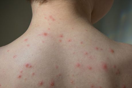 Osip, ujed stenice, dete, dečak