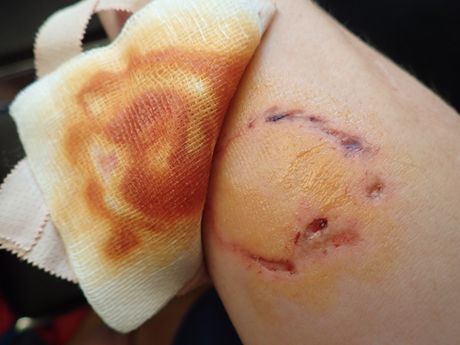 Ujed psa i komplikacije