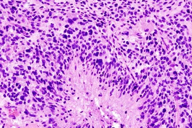 glioblastom, rak mozga