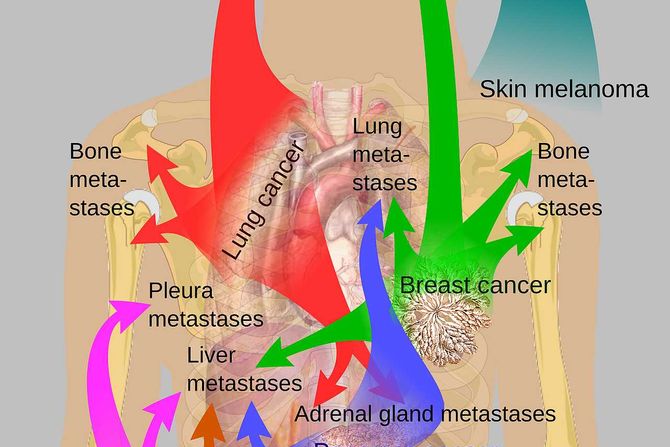 rak, kancer, metastaze