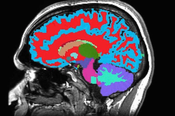 mozak, skeniranje, magnetna rezonanca