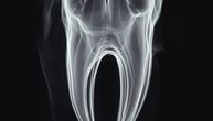 Dentalni problem izazvao infekciju oka opasnu po život