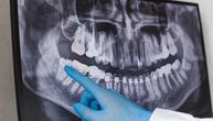 Kvarni zubi nisu samo estetski problem: Povećavaju rizik od srčanih bolesti, dijabetesa, a skraćuju i život