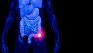 Zašto sve više mlađih ljudi oboleva od raka debelog creva? Epidemiološki obrt zabrinuo naučnike