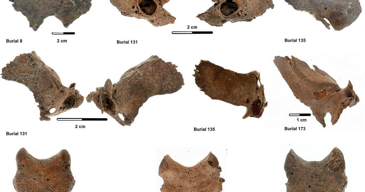 Skorbut na skeletima pronađen na arheološkim lokacijama iz kasnog holocena u Kaliforniji